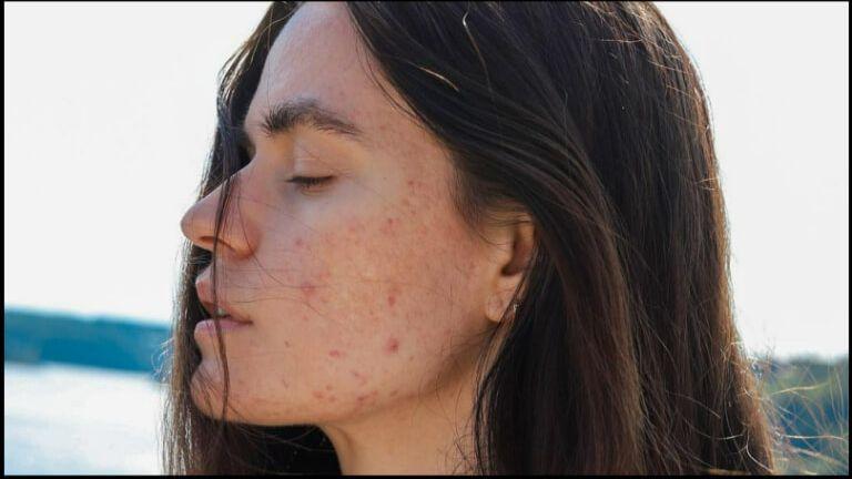 dark-spot-on-face.jpg