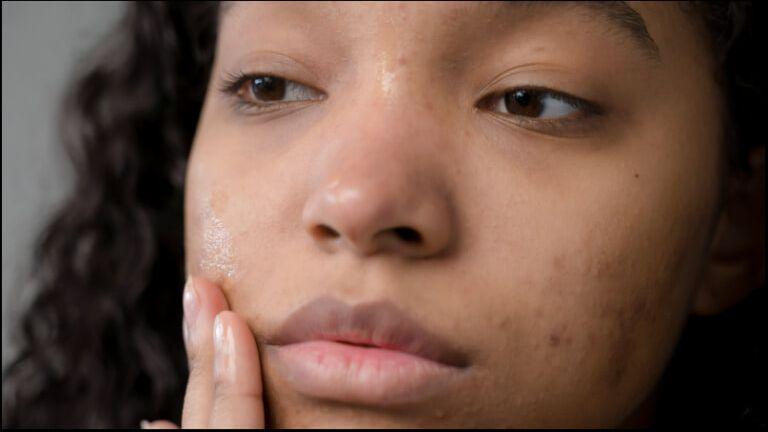 acne-vs-pimple.jpg